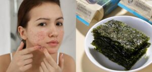 ăn rong biển giúp giảm mụn